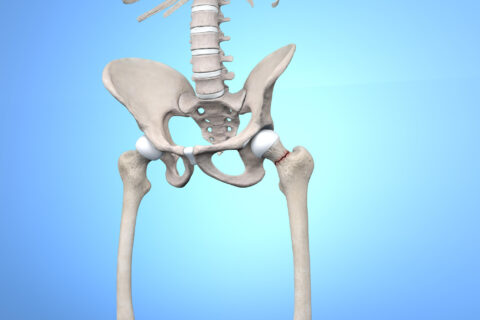 Anatomy of lower torso showing broken hip joint