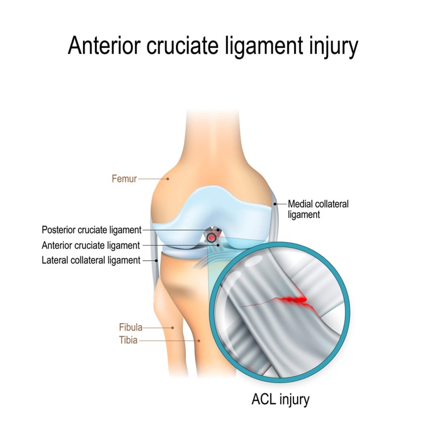 Diagram of anterior cruciate ligament injury