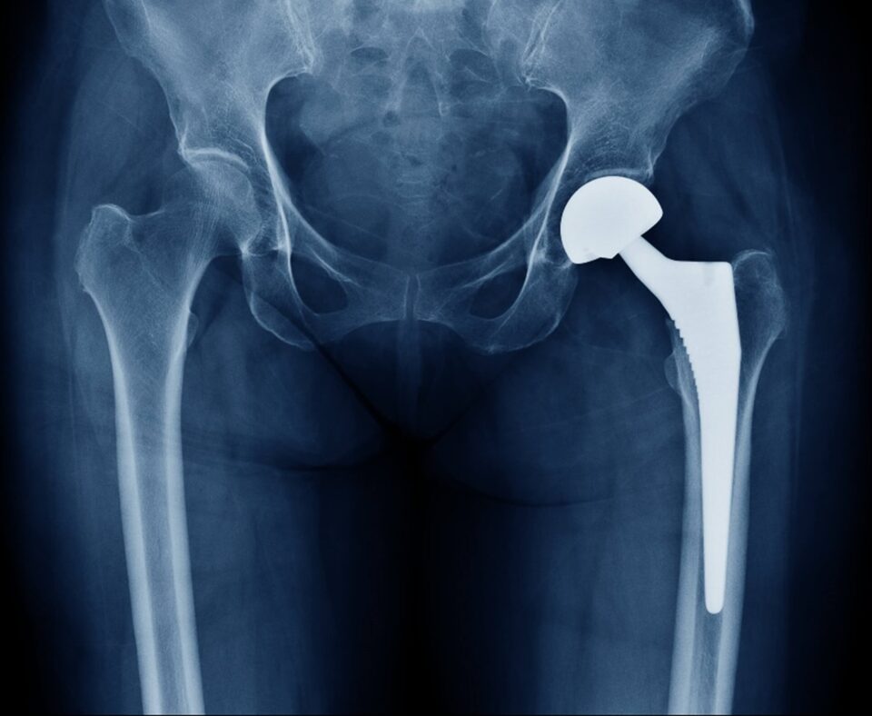 Xray showing hip replacement
