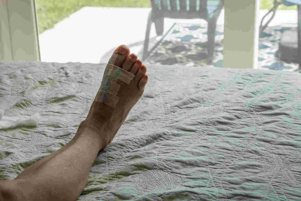 bunion treatments