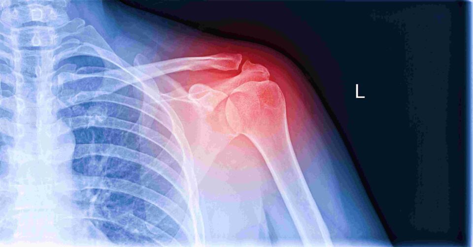 rotator cuff surgery